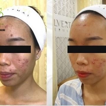 Kinh hãi và ám ảnh với những hệ lụy khi làm đẹp bất chấp với kem trộn