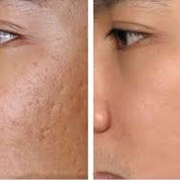 Điều trị sẹo lồi và lõm